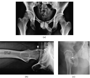 Figure 3.1: Common radiographic projections (a) Anteroposterior radiograph - taken with theleg in neutral ﬂexion and internally rotated by 15o to bring the femoral neck axis in line with thecoronal plane to provide full view lateral aspect of the femoral head-neck junction, x-ray beamparallel to the coronal plane (b) Axial cross-table radiograph - taken in supine position with leg inneutral ﬂexion and in either neutral rotation or internally rotated by 15o, x-ray beam directed tothe inguinal fold (c) False proﬁle view - to assess anterior acetabular overcoverage (Ito et al., 2001;Maruyama et al., 2001; Neumann et al., 2009; Tannast et al., 2007a).