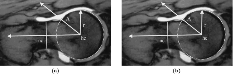 Figure 3.4: Measurement of α angle for (a) normal subjects and (b) patients with cam-typepathology.