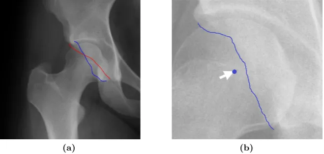 Figure 3.7: Diagnosis of acetabular retroversion or focal overcoverage2007) (a) Crossover sign (Taunton, and (b) Posterior wall sign (Laborie et al., 2011).
