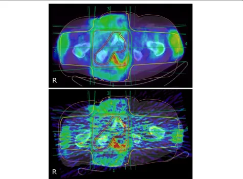 Figure 1 Transaxial overlaid 50-MV radiation treatment plan on PET/CT (0 to 30 min) image