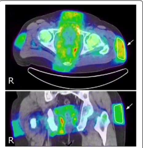Figure 2 Transaxial (upper) and coronal (lower) PET/CT(0 to 30 min) sections. The figure illustrates how VOI 1 (arrow)was drawn on the dynamic PET image in the region of the beamentrance in the subcutaneous fat.