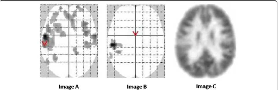 Table 4 Patients with at least one true hypometabolismusing visual, SPM-P, and SPM-A analysis