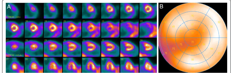 Figure 3 Representative ventricular slices and the corresponding polar map of myocardial perfusion SPECT in normal mouse.Representative short axis, horizontal long-axis, vertical long-axis slices (A) and the corresponding polar map (B) of a myocardial perfusion SPECTstudy of a normal mouse.
