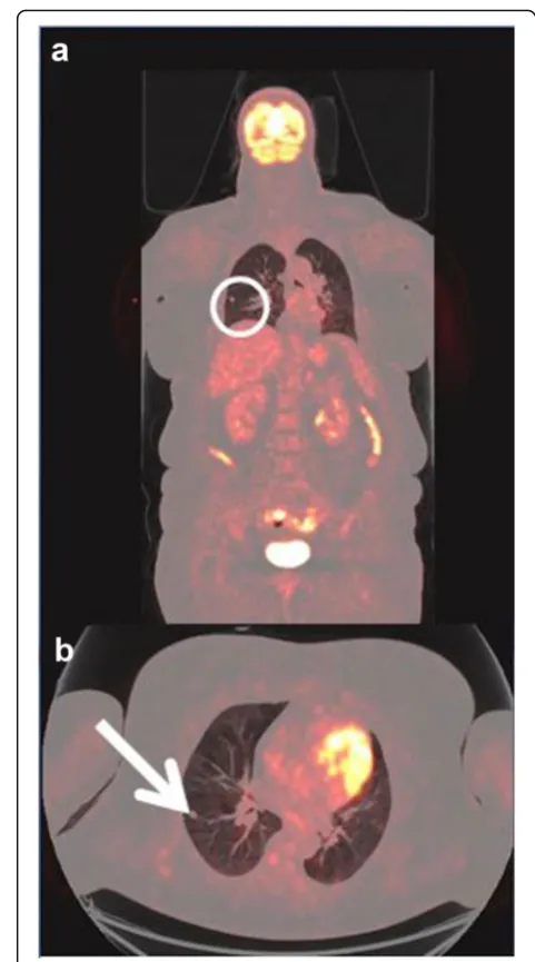 Fig. 1 a Coronal-fused FDG-PET/CT showing the region of interest(circle). b Axial-fused FDG-PET/CT showing increased uptake in thecolon and rectum (arrow)