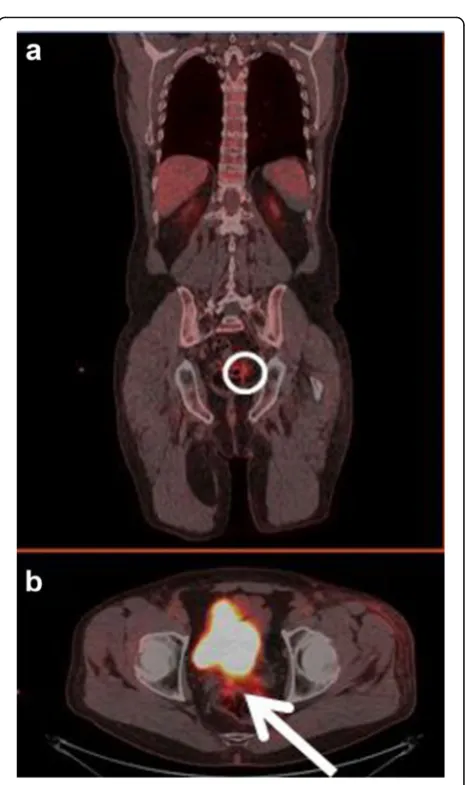 Fig. 6 a Coronal-fused FDG-PET/CT showing the region of interest(circle). b Axial-fused FDG-PET/CT showing increased uptake in thesigmoid colon (arrow)