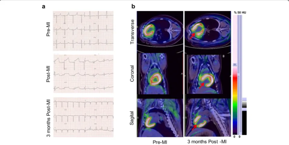 Fig. 5 Confirmation of myocardial infarction by ECG and 18F-FDG PET/CT imaging. a ECG confirmed ST segment of the anterior wall leadsdynamic changes in different time points