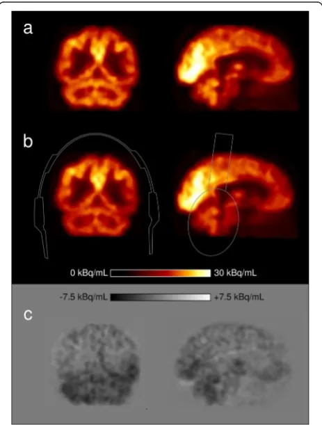 Fig. 3 Regional brain uptake analysis in 10 patients, given as PET recovery values (equals mean region uptake in scan with headphones dividedby the mean region uptake in scan without headphones)