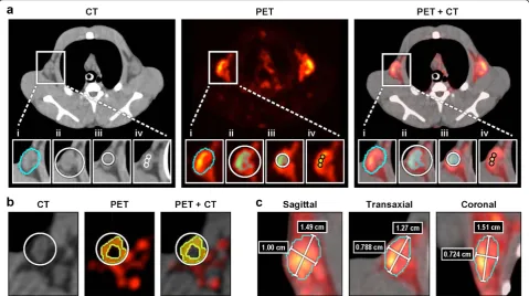 Figure 1 Definition of ROIs used forobtained on day 3placement within the LN edges. Images represent a middle slice of a LN in sagittal, transaxial, and coronal views showing the long and a short 18F-FDG uptake quantitation in the axillary LN