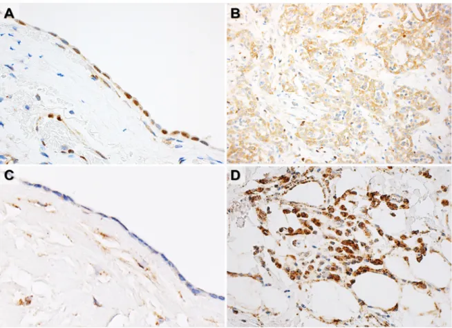 Figure 2: Representative figures of PDCD4 immunohistochemistry and in situ hybridization analysis of miR-21