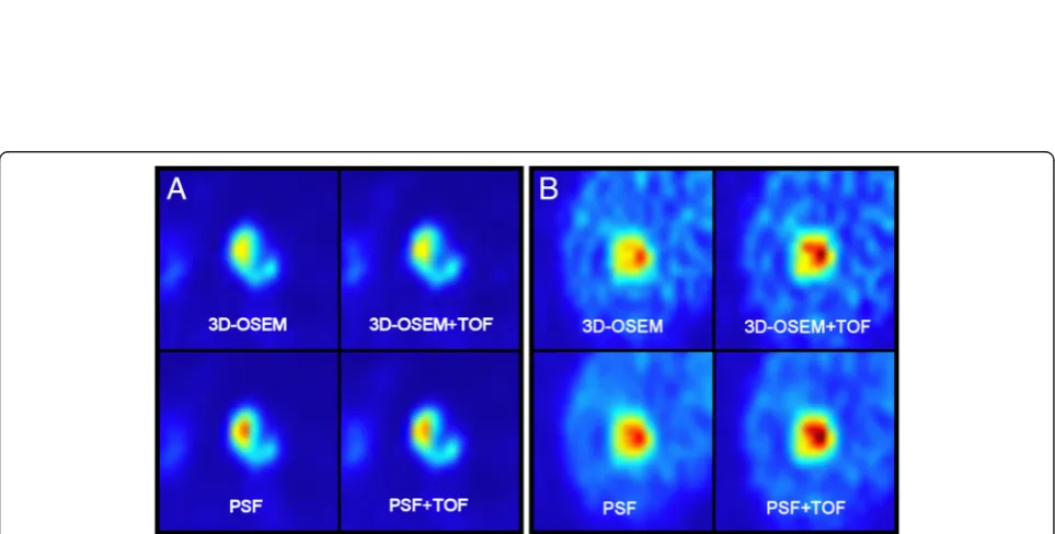 Figure 1 Relative SUVmax differences between reconstruction algorithms. Box plots of relative SUVmax differences in lesions with low TBR andhigh TBR