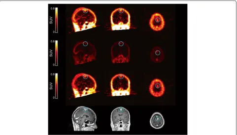 Figure 5 Image data for patient 10. The image data show radioactivity distribution in normal brain and cerebral metastases (enclosed in bluecircle) (top panel) and are separated into non-blood (middle upper panel), blood (middle lower panel) and correspond