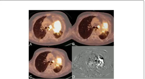 Figure 3 Original (A), elastix adjusted (B), and subtraction(C) maximum intensity projection of patient 6
