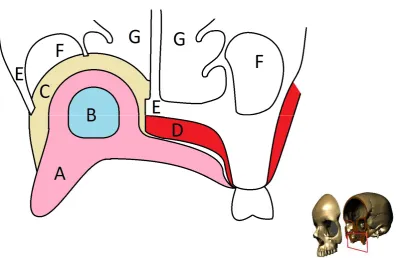Figure 6: Coronal view of the maxilla, after maxillectomy, with obturator (A), hollow bulb (B), and soft lining material (C)