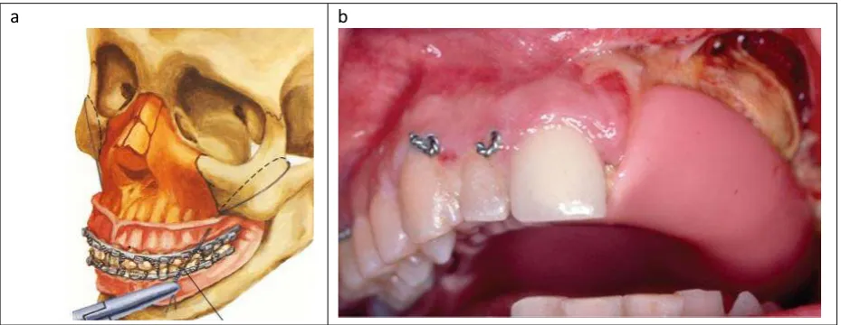 Figure 7: Illustration of fixation using zygomatic wire(the black loop) (a) and dental wire(b)[29]