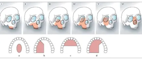 Figure 2: Brown’s classification. Vertical classification: I—maxillectomy not causing an oronasal fistula; II—not involving the orbit; III—involving the orbital adnexae with orbital retention; IV—with orbital enucleation or exenteration; V—orbitomaxillary 
