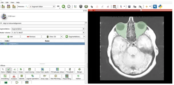 Figure 17: Screenshot of segmentation with 3D slicer