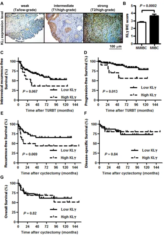 Figure 5:  (A) KLγ was expressed in urothelial carcinomas of the bladder and the expression level gradually increased as tumors progressed  to higher stages and grades