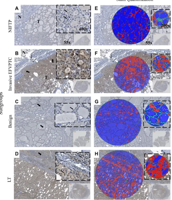 Figure 1: Immunohistochemistry staining and digital image analysis of PD-L1 expression in NIFTP, invasive EFVPTC,  Benign and LT