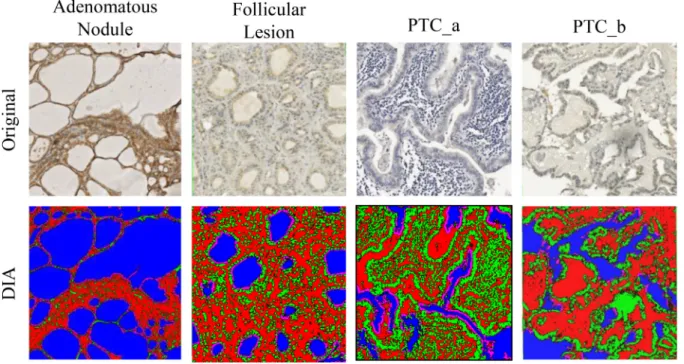 Figure 4: Application of ThyApp to PD-L1 expression analysis in thyroid tissues.  The developed algorithm using  histomorphological approach was used for quantitation of PD-L1 expression on Nanozoomer scanned images representing distinctive  diseased thyro