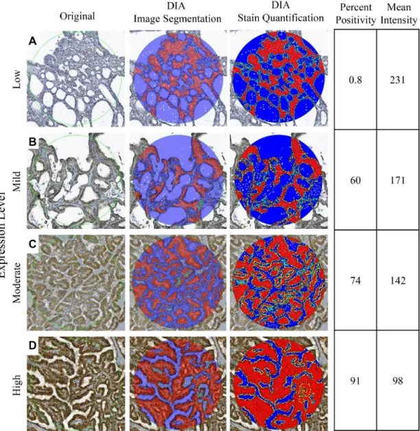 Figure 5: Reflectance of IHC staining.  Representative digital images of low (A), mild (B), moderate (C), and high (D) PD-L1  expressions were digitally analyzed by ThyApp