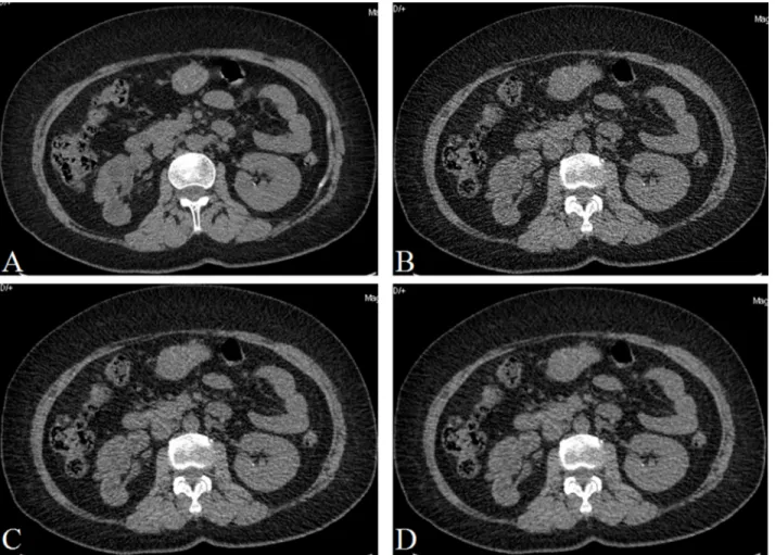Figure 3: A 50 years old man with a small stone (1.8 mm × 1.6 mm × 1.7 mm) in the left renal