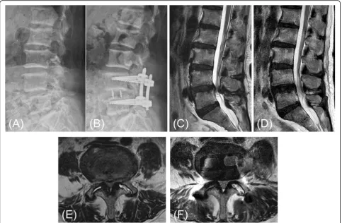 Table 5 Radiographic measures- Canal dimension (CSA anddiameter of dural sac) changes evaluated on pre-andpostoperative MRI