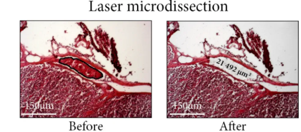 Figure 1:  (A) Laser microdissection of the intra-lymphatic embole of tumor cells. Lymph node section, hematein-eosin staining