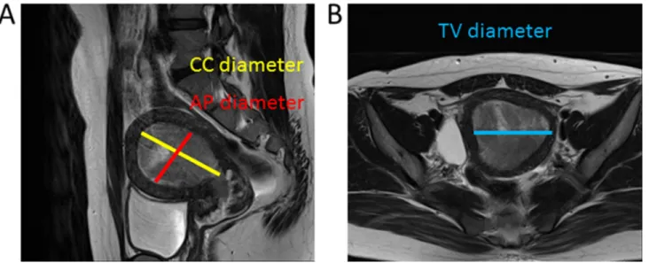 Figure 3: Images used to determine tumor diameter.  The maximum tumor diameters were determined along three orthogonal  planes