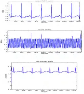 Fig 6:De-noising of ECG signal using IIR notch filter 