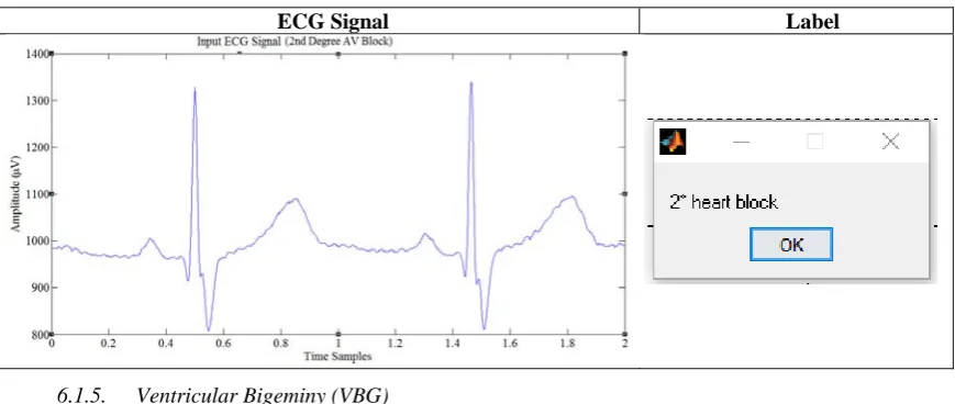 Table 9 Second Degree AV Block 