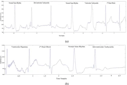 Table 12: Analysis of different beats using proposed algorithm 