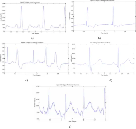Fig 2.ECG with normal and abnormal beats: a)NSR, b)IVT, c)VTR, d)SDB, e)VBG 