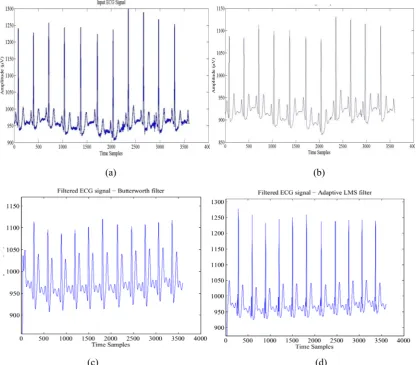 Figure 3. Preprocessing ECG signal for noise reduction: Contaminated ECG in (a) and filtered ECG using FIR low pass filter in (b), Butterworth filter in (c) and adaptive LMS filter in (d)