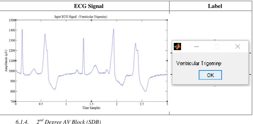 Table 7 Ventricular Trigeminy 