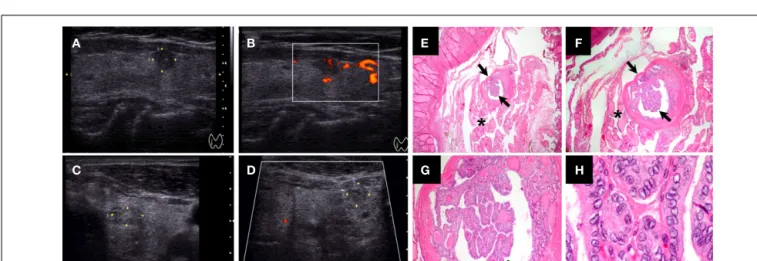 FIGURE 1 | Ultrasound and histological characteristics of a papillary thyroid microcarcinoma (PTMC) nodule
