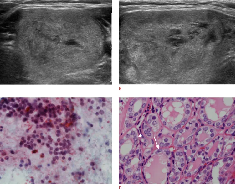 Fig. 1. An incidentally detected thyroid mass in a 32-year-old woman. 