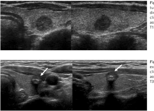 Fig.  1. Left papillary thyroid cancer, tumor size is 1.0 cm in greatest dimension, limited to the thyroid, clinical staging T1a lesion