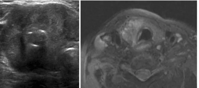 Fig. 3. 74-year-old female with papillary thyroid carcinoma with tracheal invasion.
