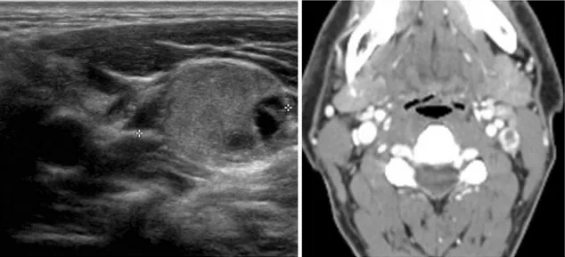 Fig. 7. 34-year-old female with papillary thyroid carcinoma and metastatic lymph nodes