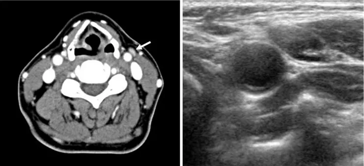 Fig. 1. CT and sonography of the 57-years-old female patient with papillary thyroid cancer
