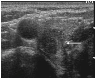Fig.  2.  Sellar  MRI  shows  9  ×  6  mm  sized  microadenoma  in  left  portion  of  pituitary  gland.