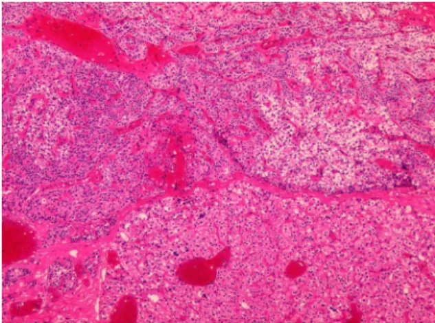 Fig.  3.  Abdominal  dynamic  CT  shows  6.8  mm  sized  arterial  enhancing  mass  at  pancreatic  body.