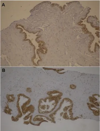 Figure 3. Distribution of microvessel density (CD34 þ) in the control and cancer groups