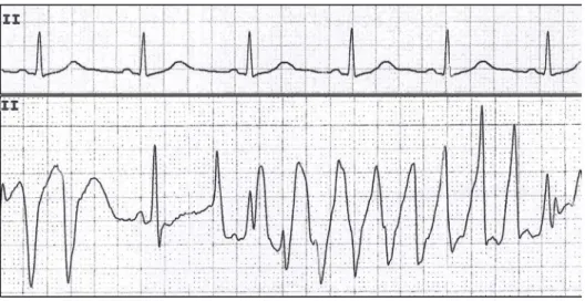 Figure 3 Arsenic trioxide blocks both I Kr  and I Ks  at  clinically relevant concentrations and activates the I K-ATP which maintains normal repolarization [17]