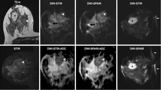 Figure  1 illustrates the use of the two fat suppres- suppres-sion techniques in the case of a 38-year-old woman with  an invasive ductal carcinoma on the right breast (superior  quadrant), near a large simple cyst.