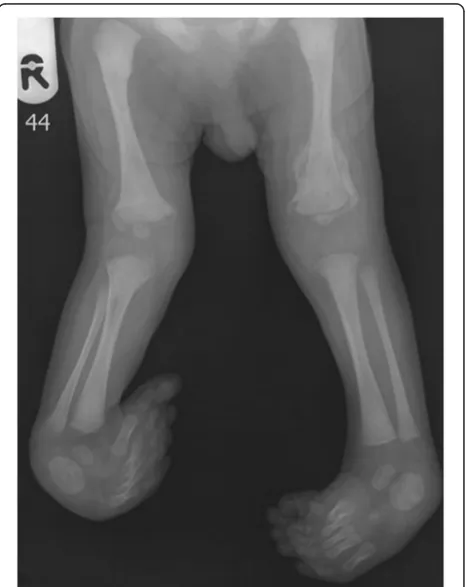Figure 2 The third day of life – the whole figure – noticeablefree thumbs and apparent dislocation on the left knee-joint.