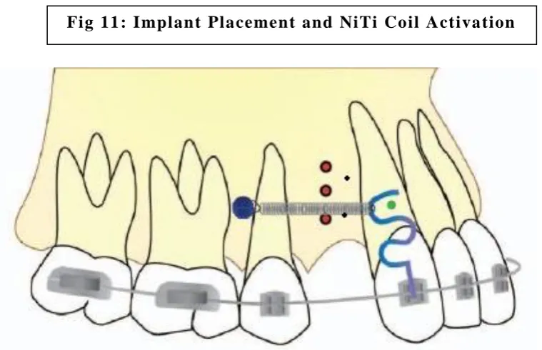 Fig 11: Implant Placement and NiTi Coil Activation  