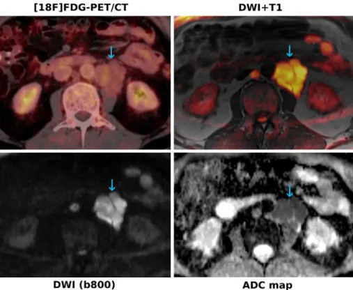 FIGURE 1: A 62-year-old patient with small-cell lymphocytic lymphoma (SLL). The paraaortic nodal manifestations (blue arrows) show only very subtle [ 18 F]FDG uptake on PET, whereas they show a clearly restricted diffusivity, with high signal on the b-800 