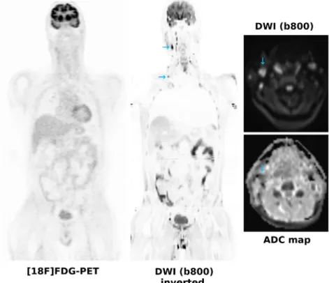 FIGURE 2: A 42-year-old patient referred with a clinical suspicion of lymphoma. [ 18 F]FDG-PET is negative, whereas DWI shows several small cervical lymph nodes with a long axis diameter <1.5 cm (blue arrows) that show a moderately restricted diffusivit
