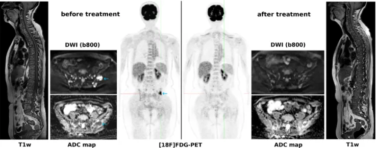 FIGURE 3: A 60-year-old patient with multiple myeloma. While DWI captures multiple focal lesions with restricted diffusivity in the pelvic bones, [ 18 F]FDG-PET captures just a single lesion with extension through the cortical bone into the soft tissues (b